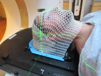 Radiation Therapy Thermoplastic Mask | OncoLink