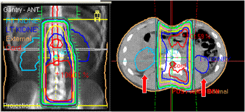 Radiation Therapy Which Type Is Right For Me Oncolink
