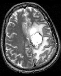 Frontal Lobe Brain Tumor Mri