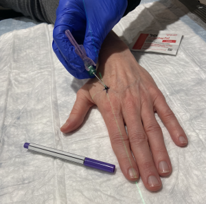 Radiation Therapy Tattoos | OncoLink