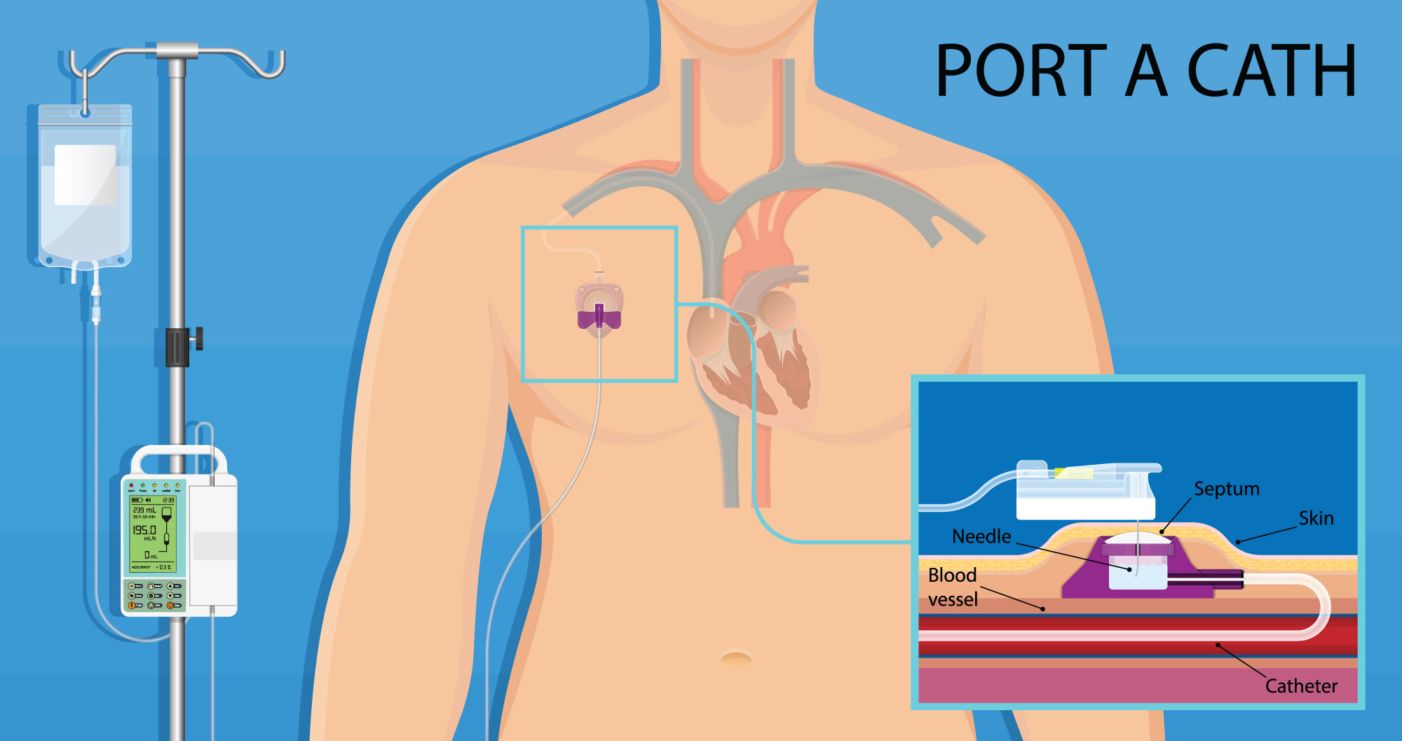 How To Draw Blood From Mediport How To Draw Blood From Mediport